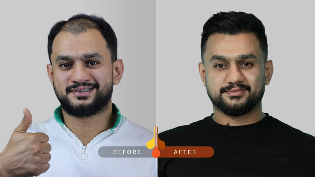 Hair Transplant