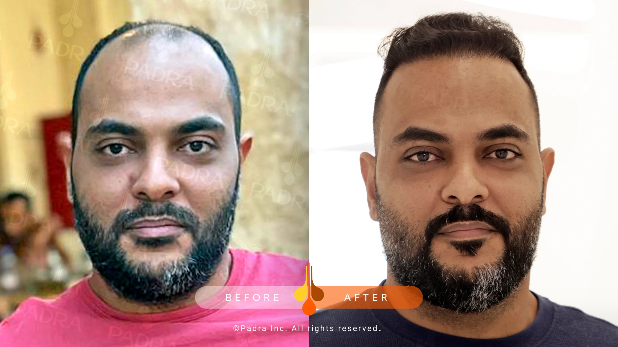 hair transplant in qatar (3)