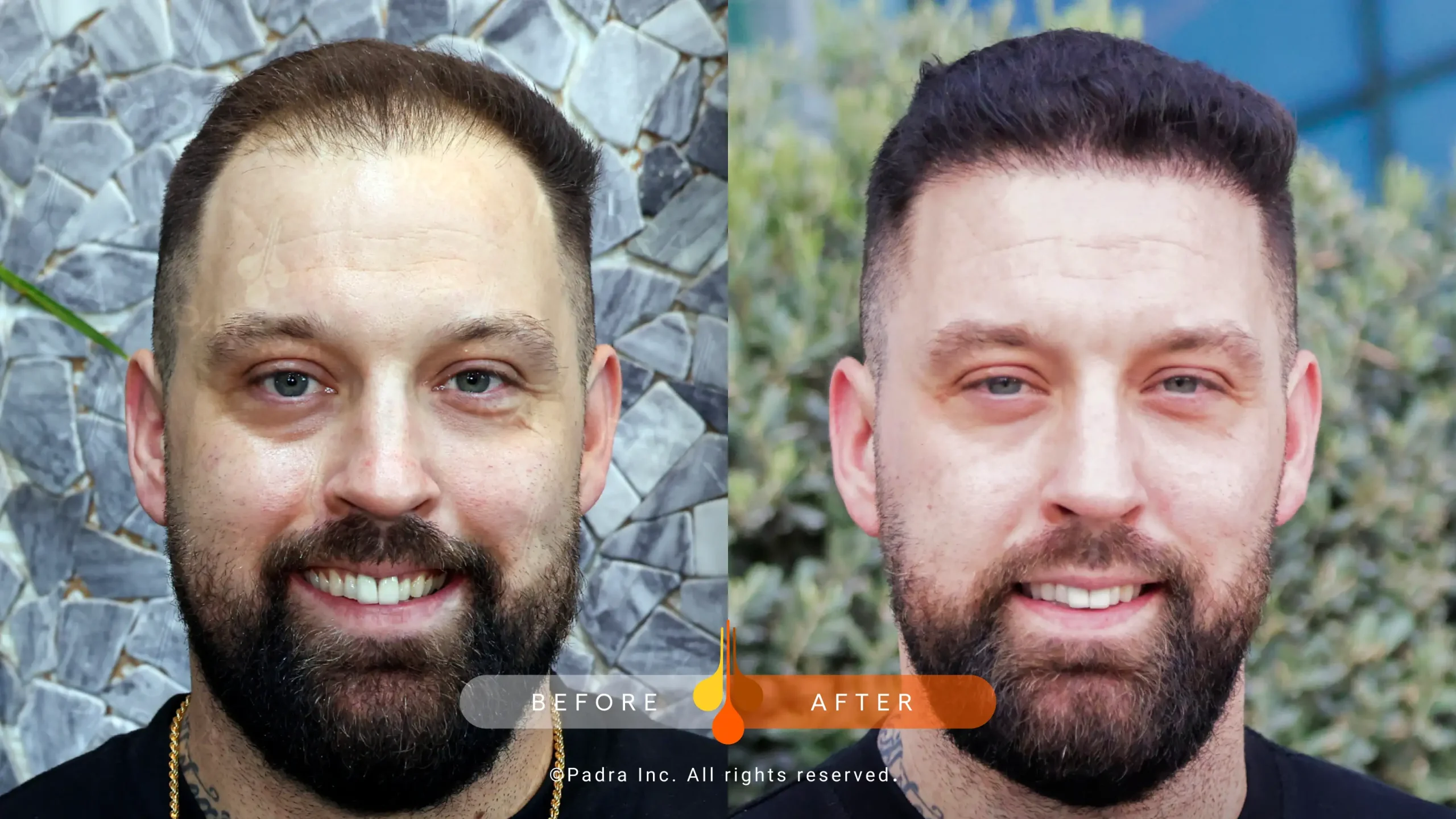 hair transplant in qatar (4)