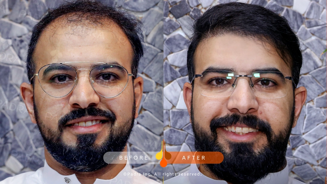 hair transplant in qatar (5)
