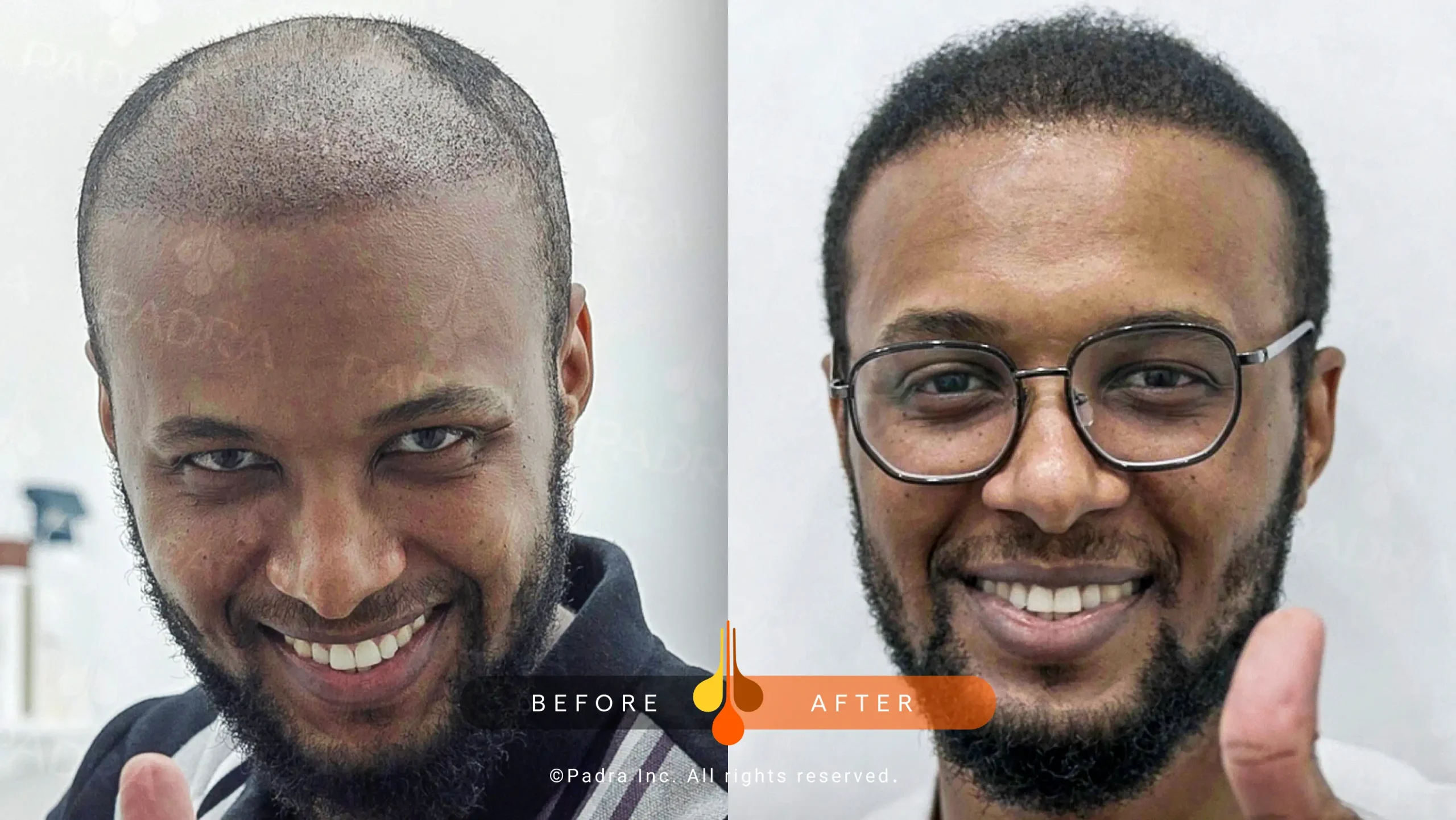 hair transplant in qatar (8)