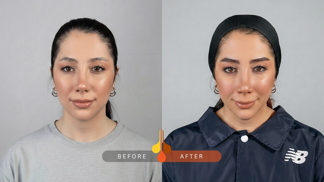 result of eyebrow transplant