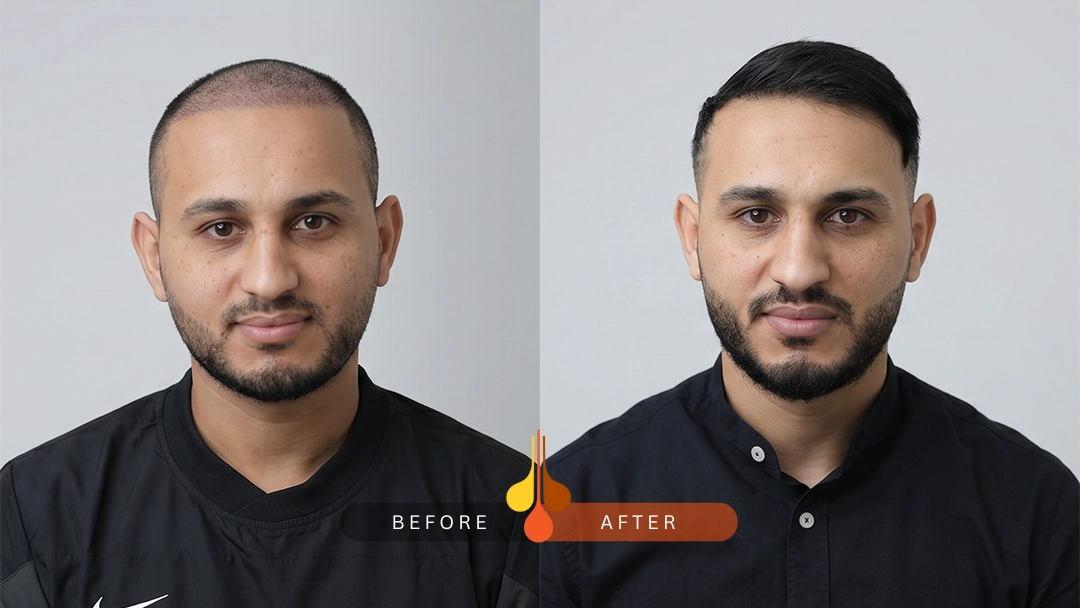 Long-term hair transplant results at Padra Clinic Saudi Arabi