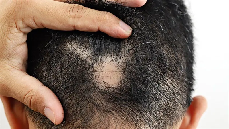 Advanced Alopecia Areata Treatment 