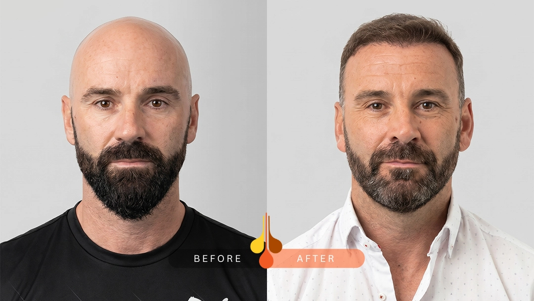 Successful FUE hair transplant before and after in Dubai
