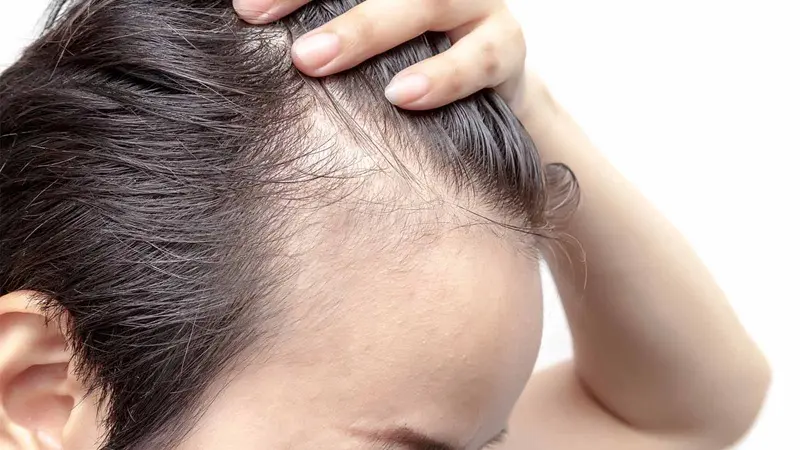 Advanced Alopecia Areata Treatment 