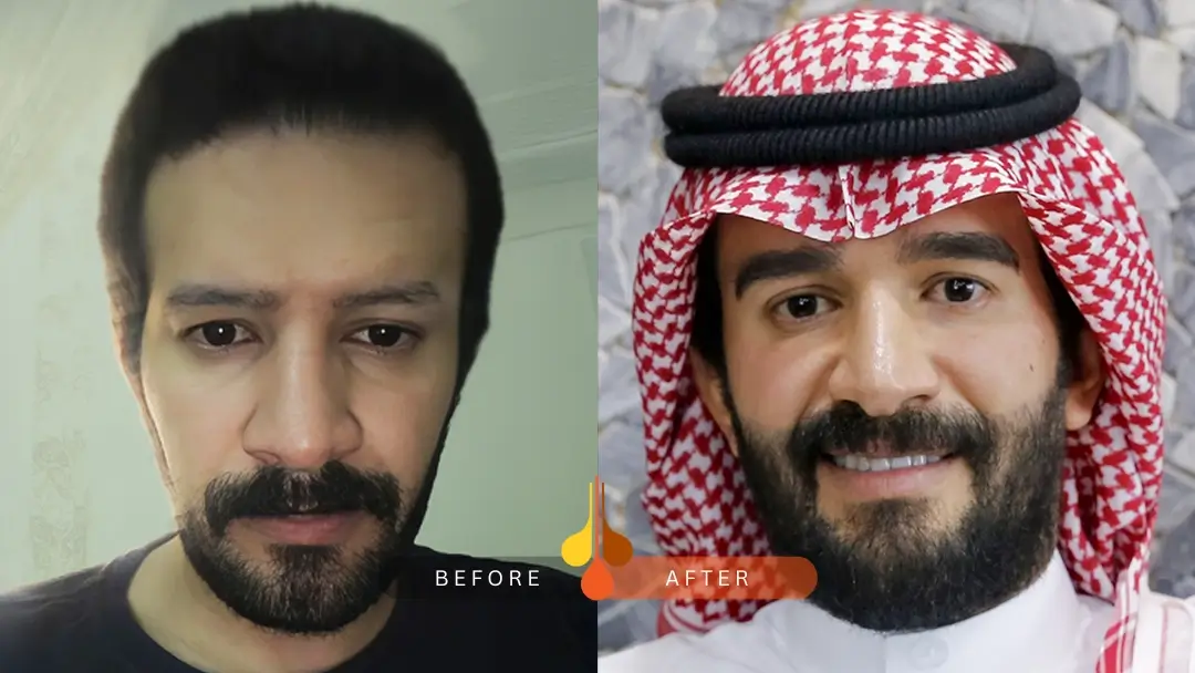 eyebrow transplant before and after: sample 1