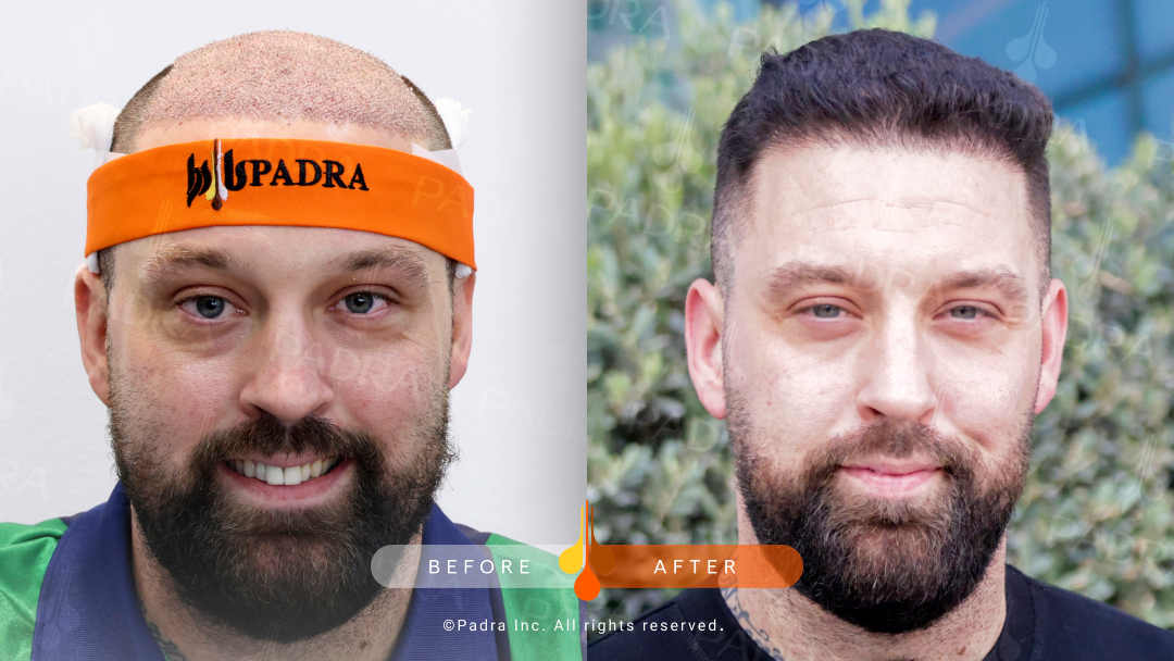 Before and after hair transplant results at Padra Clinic Dubai