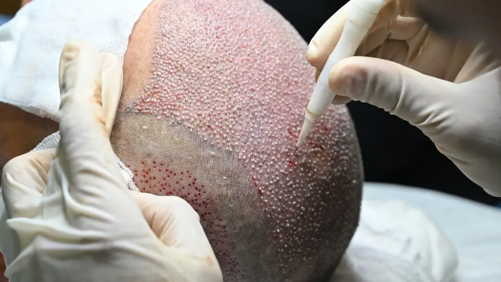 DHI Hair Transplant