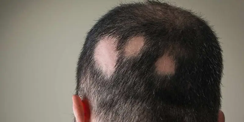  Spectrum of Alopecia