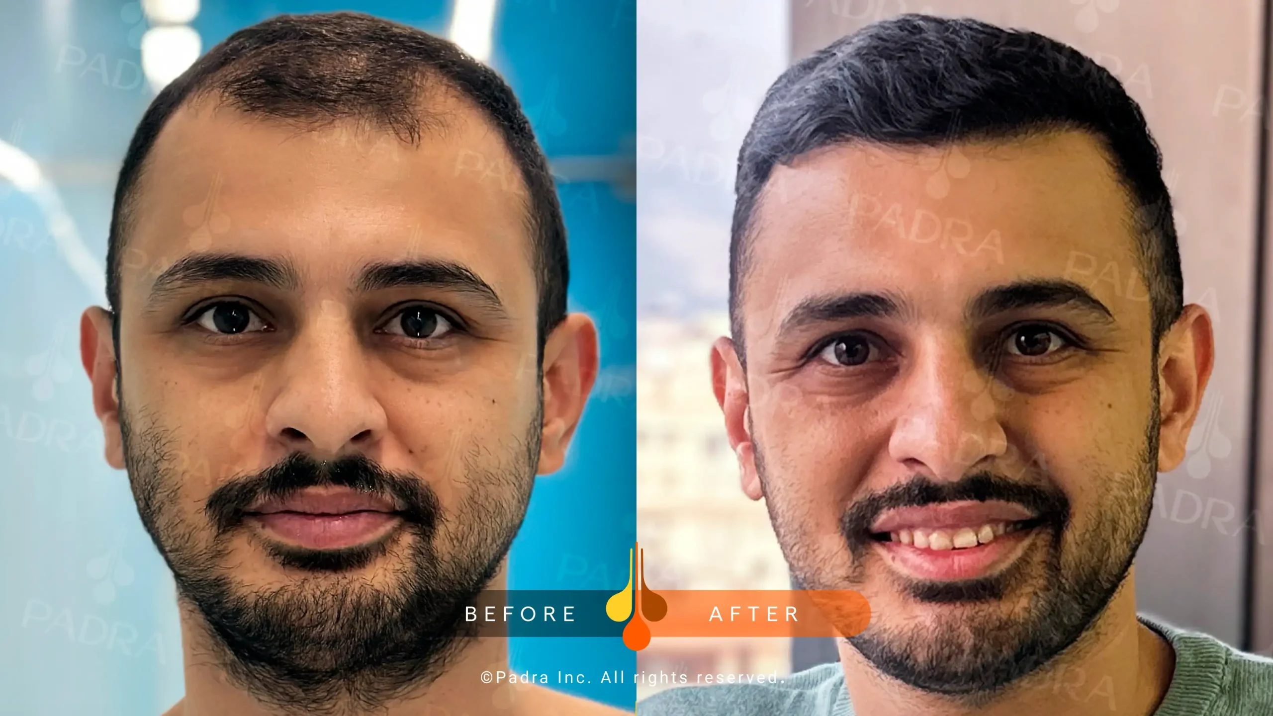 Real hair transplant results at Padra Clinic Kuwait