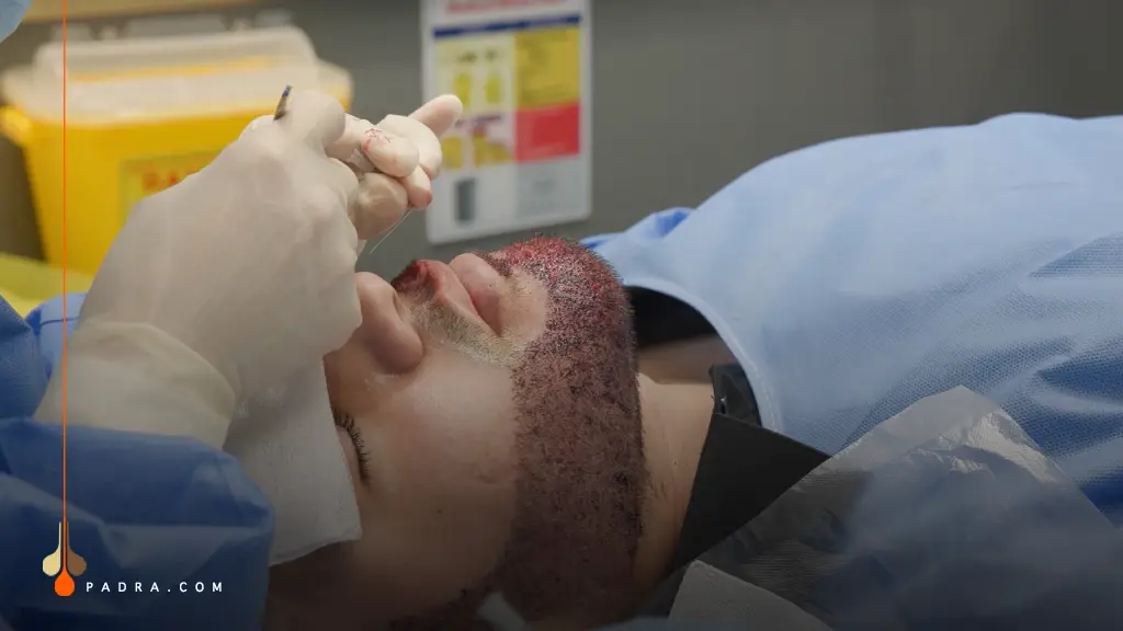 Beard Transplant graft implantation