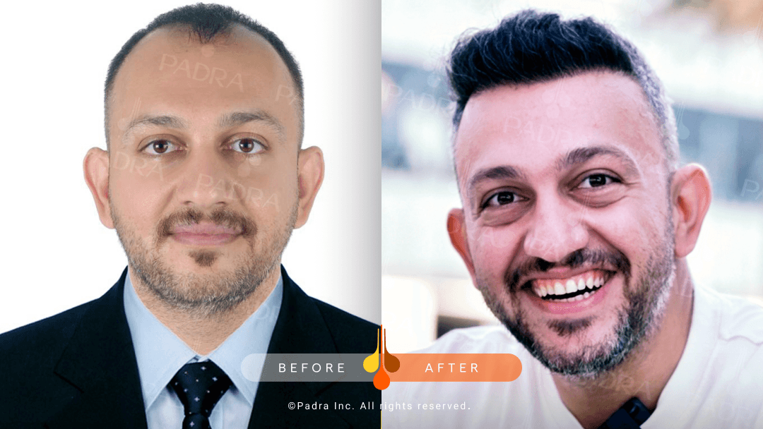 Natural hairline transformation in Kuwait