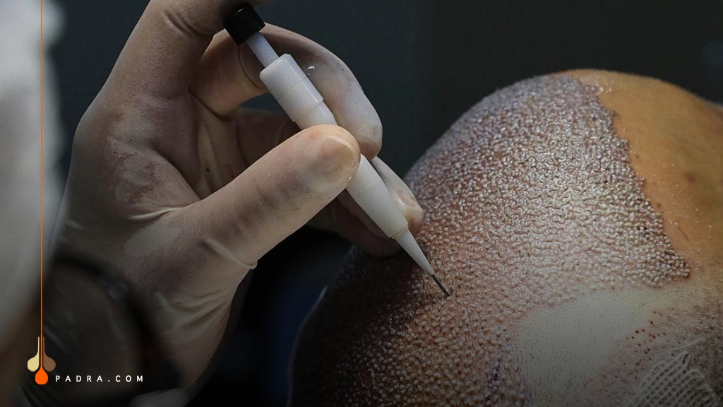 DHI hair transplant and choi pen