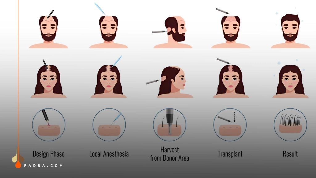 DHI Hair Transplant Procedure