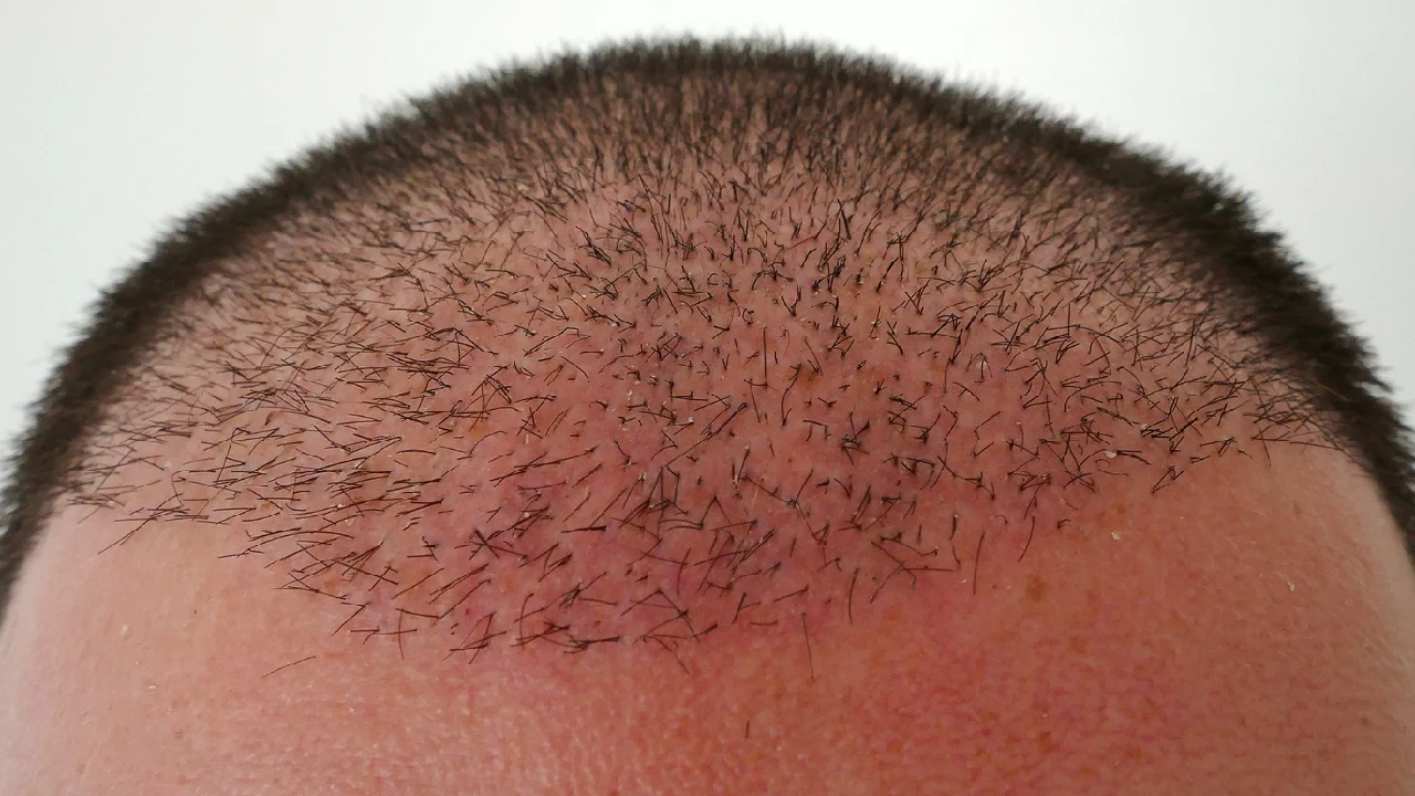 excessive hair loss after hair transplant