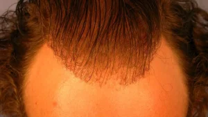 unnatural hairline after hair transplant