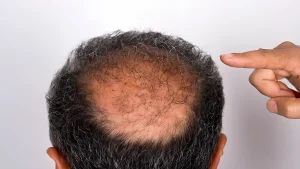 patchy hair growth after hair transplant