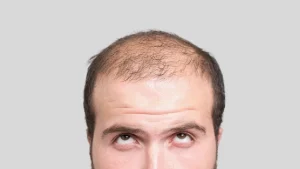 man going bald