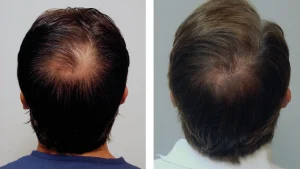 crown hair transplant before and after