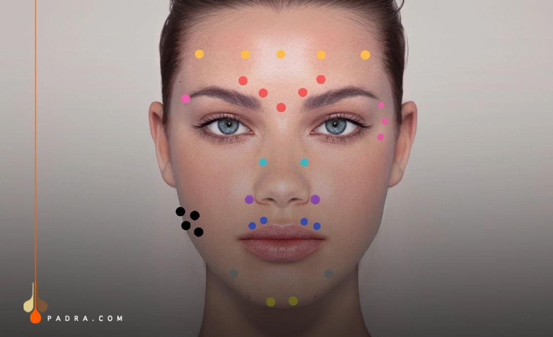 injection sites of botox on the face