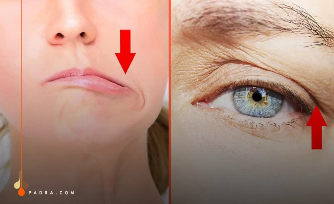 demonstration of muscle weakness caused by botox