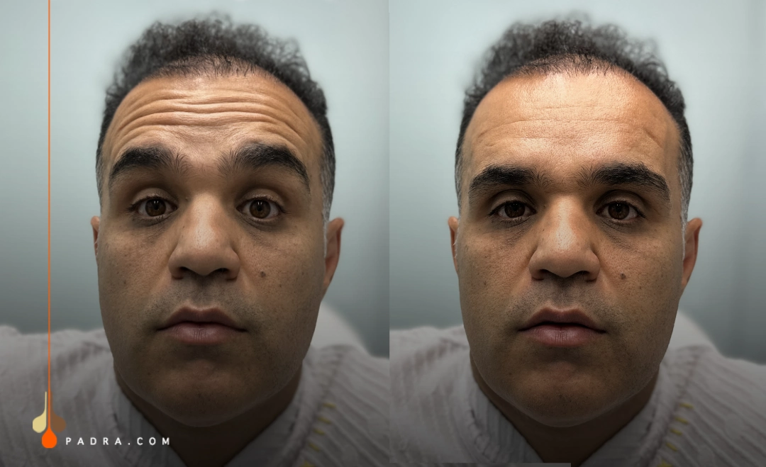 man before and after forehead botox
