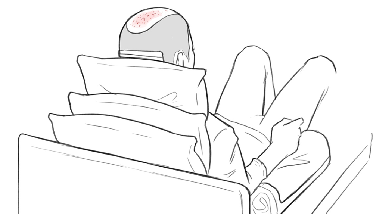 illustration of man with elevated head on multiple pillows after hair transplant