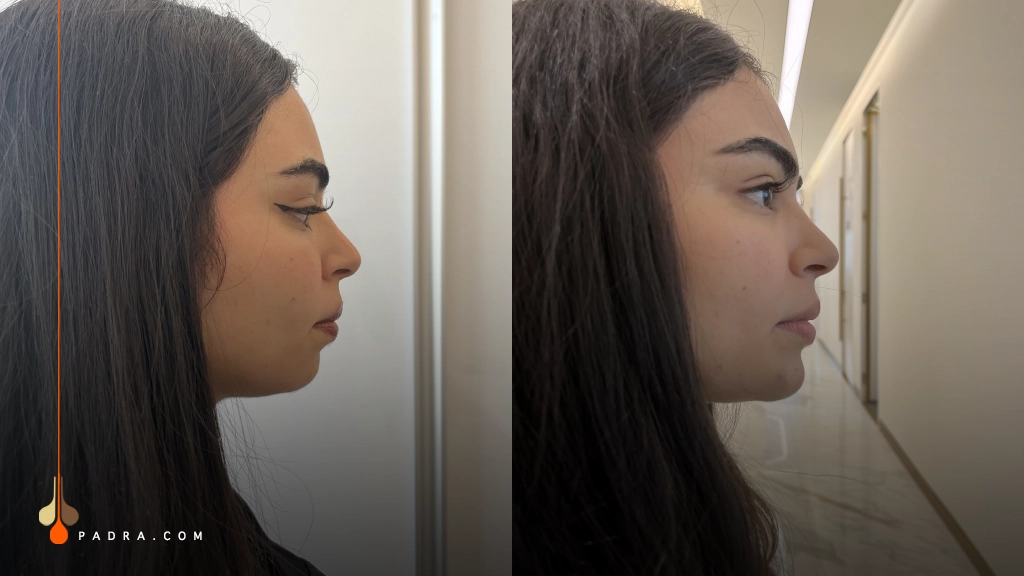 chin filler before and after