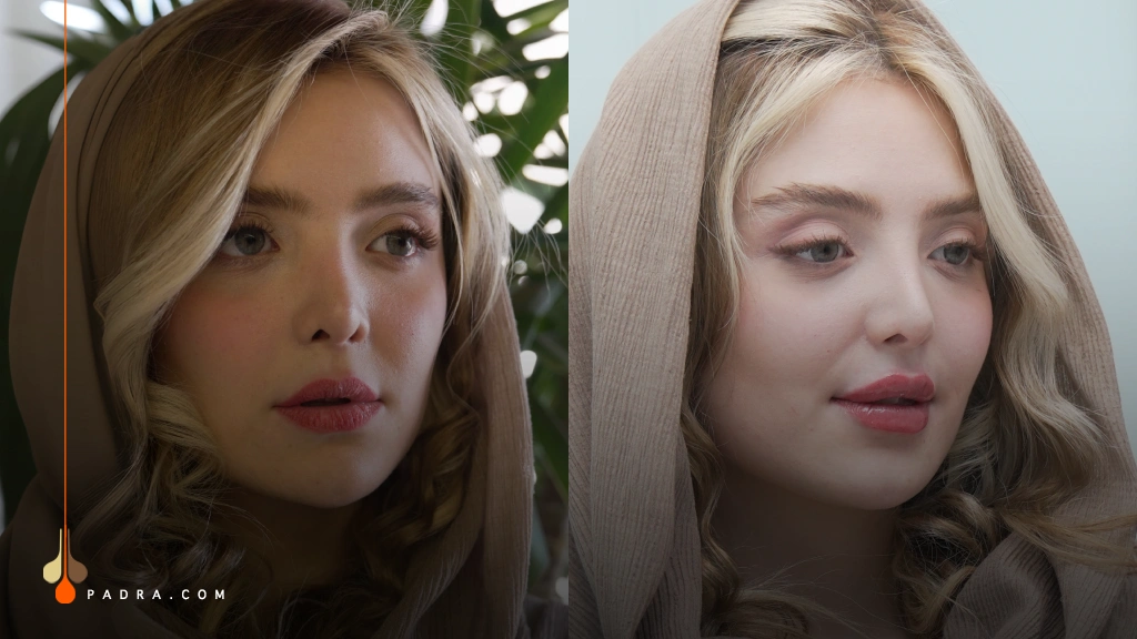 lip filler injection before and after