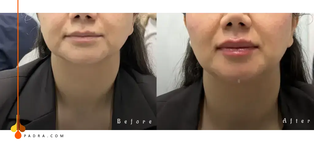 lip filler in padraclinic