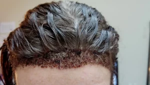 infected hair implant site