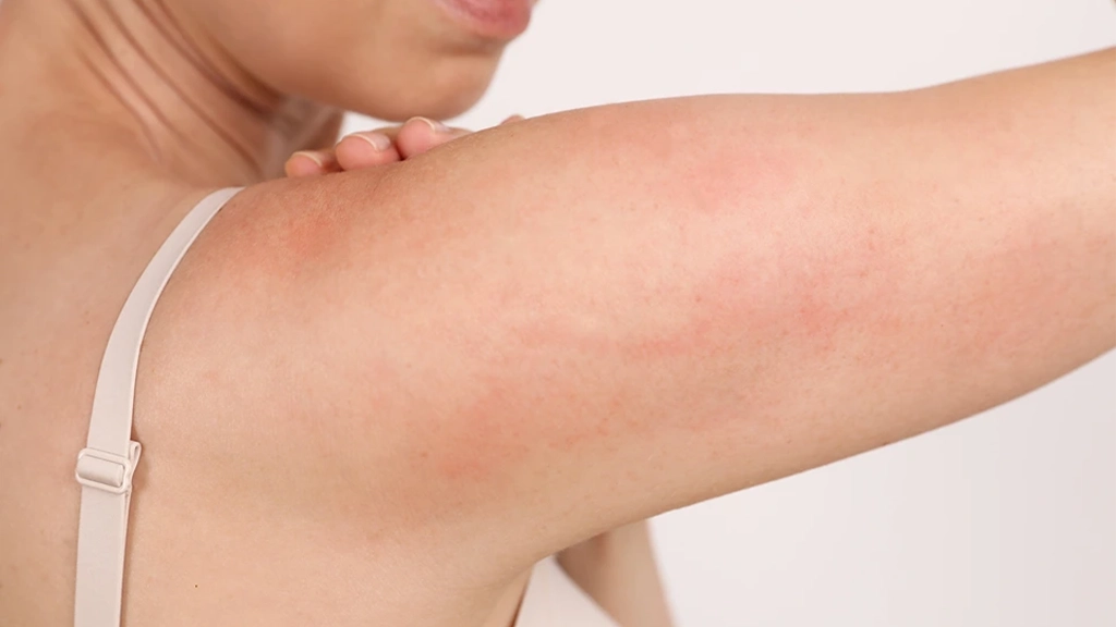 Laser Hair Removal