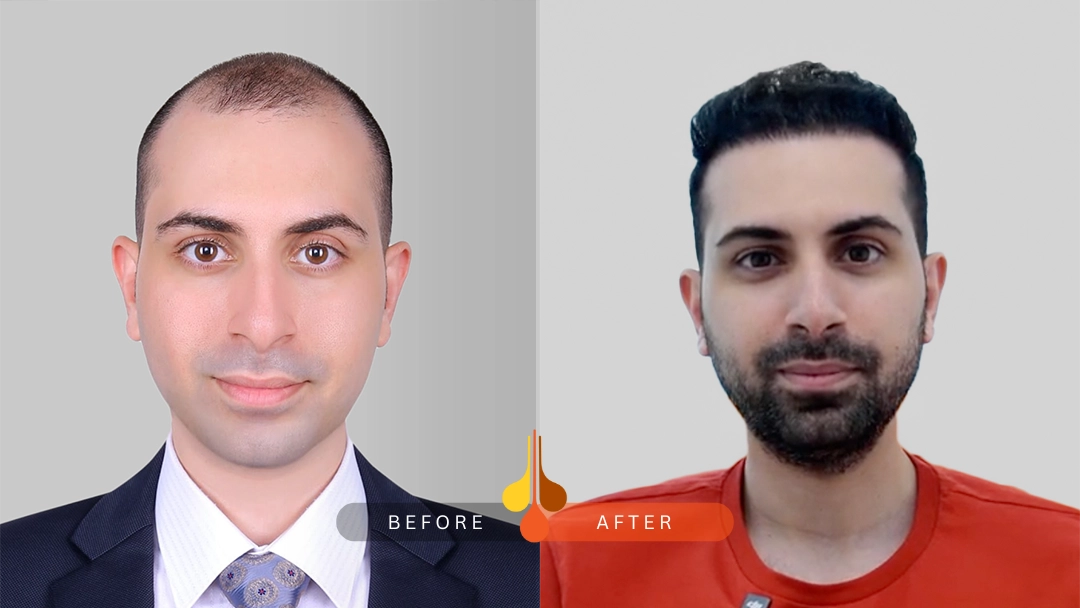 Before and after hair transplant results at Padra Clinic Dubai