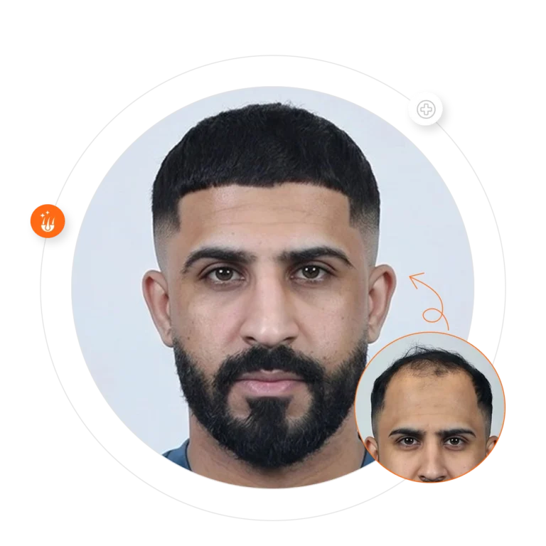 result of hair transplant in Riyadh