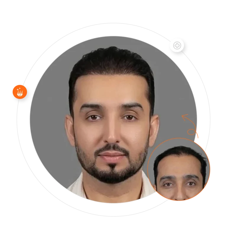 Before and after hair transplant at Padra Clinic Kuwait