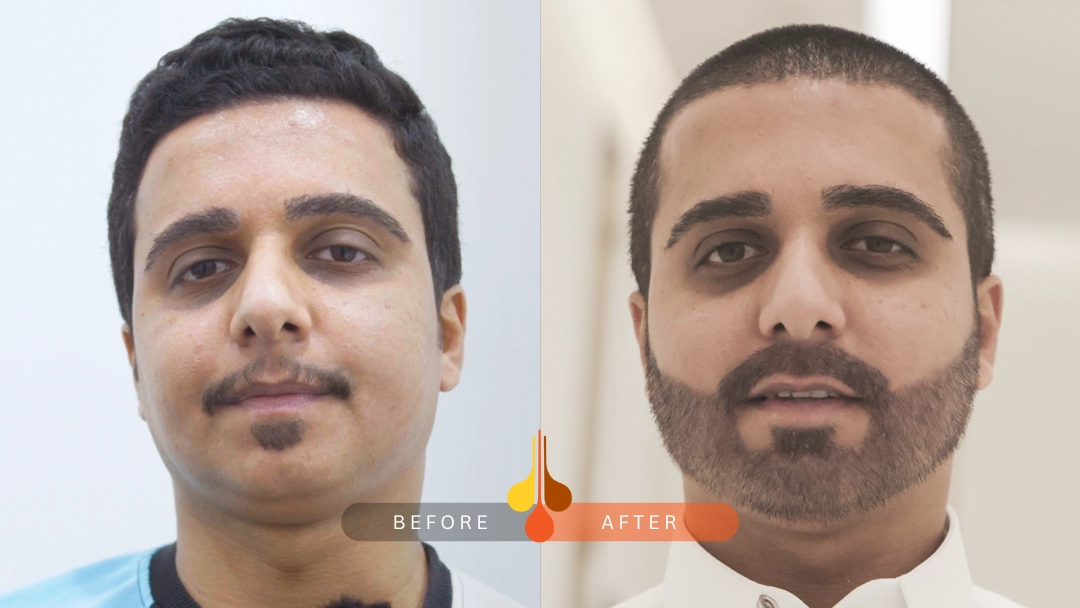 hair transplant before and after results in Padra: sample 1