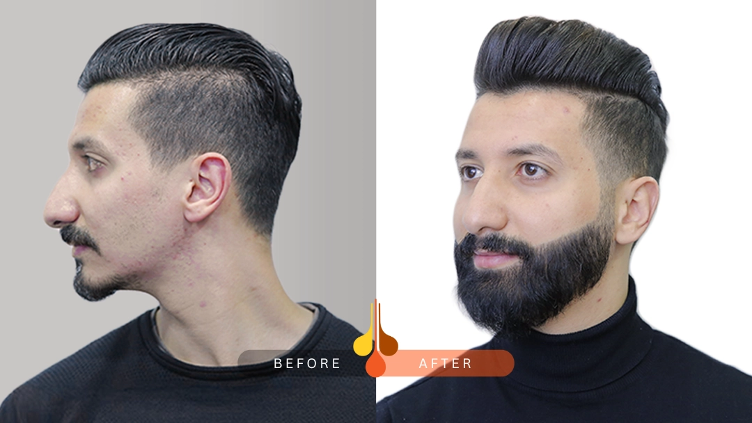 Full beard restoration in Saudi Arabia