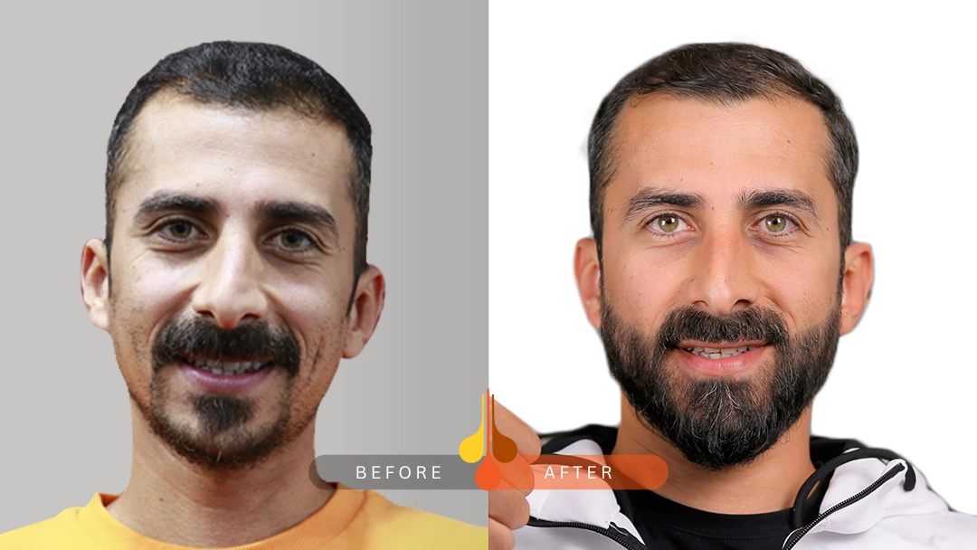 beard transplant Dubai before and after