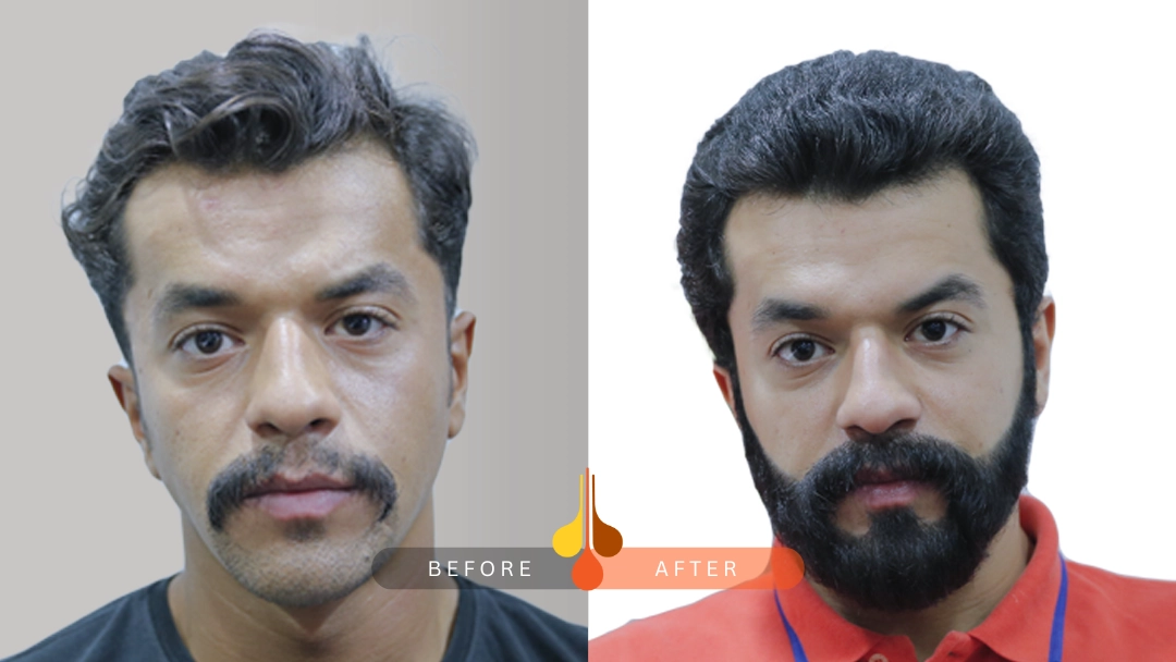 hair transplant before and after results in Padra: sample 2