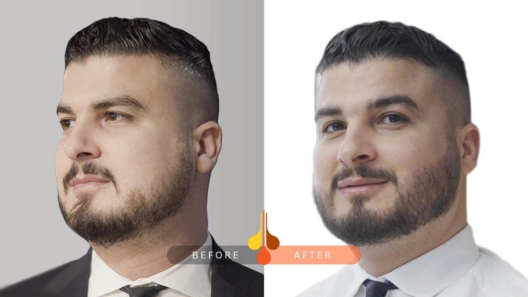 beard transplant ksa before and after