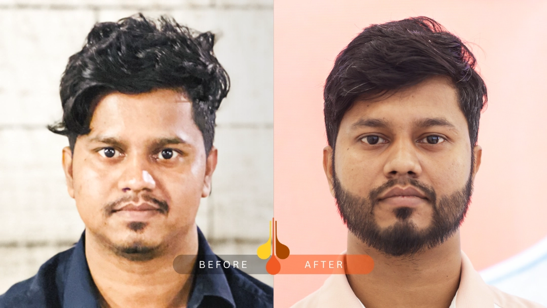 Before and after beard transplant at Padra Clinic Riyadh