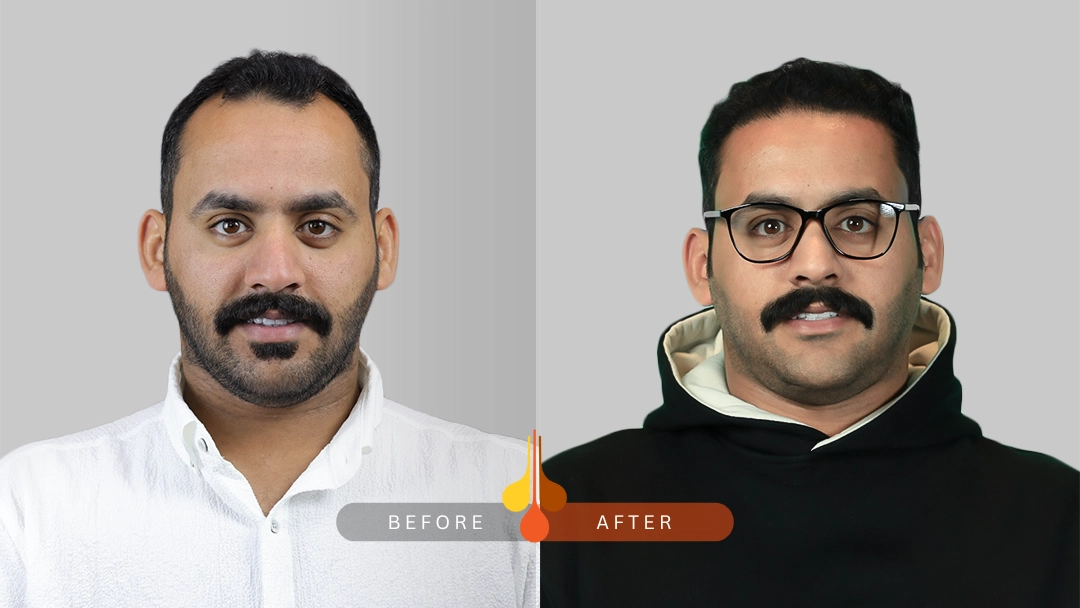 hair transplant Kuwait before and after