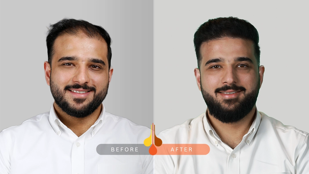 Natural hair transplant results in Kuwait