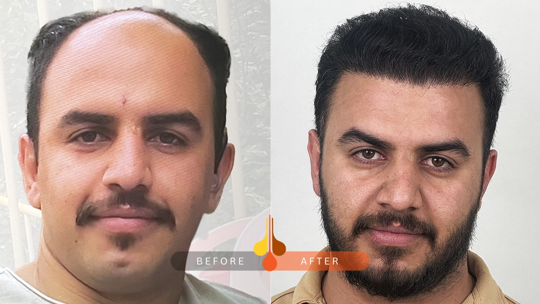 صور قبل و بعد زراعه الشعر2