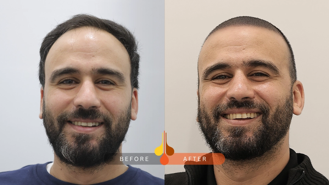 Before and after hair transplant results at Padra Clinic Riyadh