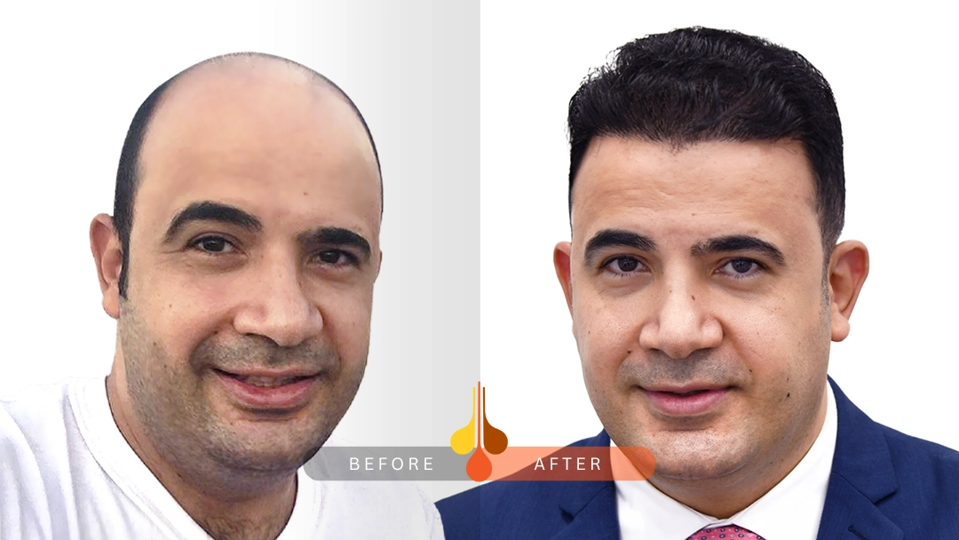 result of hair transplant in Kuwait