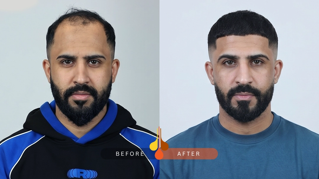 Hair transplant transformation in Doha