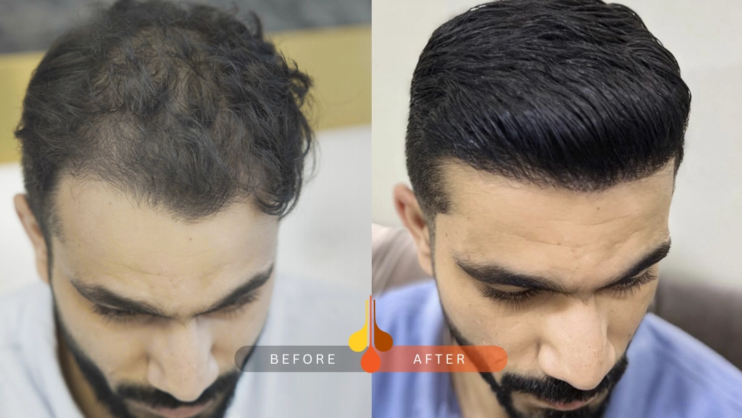 Natural hair transplant results in Qatar