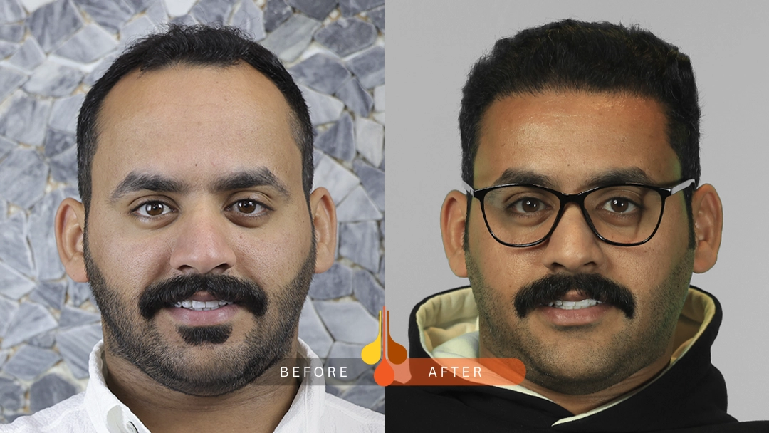 Before and after hair transplant at Padra Clinic Doha